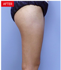 韩国JYP整形外科腿部抽脂案例对比