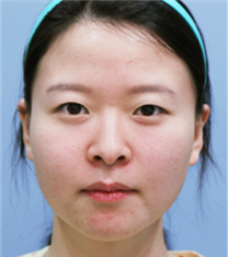 韩国JYP整形外科-韩国JYP整形外科双眼皮整形对比图