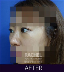 韩国Rachel整形医院双眼皮修复案例对比图