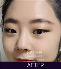 韩国Rachel整形医院misko隆鼻案例对比图