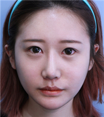 韩国JYP整形外科-韩国JYP整形外科隆鼻案例对比图