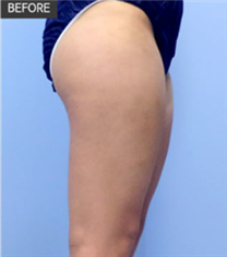 韩国JYP整形外科腿部抽脂案例对比