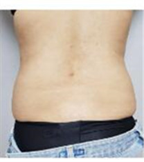 韩国维摩整形外科-韩国维摩整形外科腰腹吸脂对比图