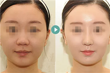 面部埋线提升能维持多久，术后要注意什么？