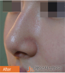 韩国JSTAR整形医院-韩国JSTAR整形医院驼峰鼻矫正案例