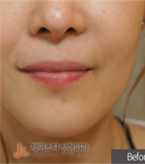 韩国JSTAR整形医院-韩国JSTAR整形医院瘦脸针案例