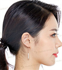 JK整形美容医院-韩国jk医院3D鼻整形+眼整形+额头提升对比案例