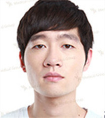 JK整形美容医院-韩国jk整形外科双眼皮前后对比案例