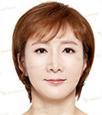 JK整形美容医院-韩国jk整形外科中年眼手术+迷你提升对比日记