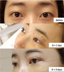 JK整形美容医院-韩国JK整形外科双眼皮手术对比日记