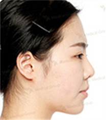 JK整形美容医院-韩国jk医院3D鼻整形+眼整形+额头提升对比案例