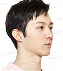 JK整形美容医院-韩国jk医院3D鼻整形案例