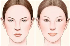 案例分析：下巴整形+眼鼻综合整形后会怎么样？