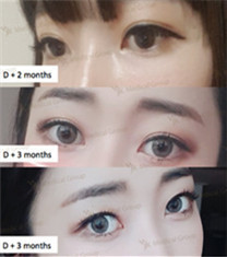 韩国JK整形外科双眼皮手术对比案例