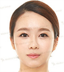 JK整形美容医院-韩国jk整形外科全脸自体脂肪填充案例