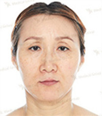 JK整形美容医院-韩国jk整形外科中年眼手术+迷你提升对比日记