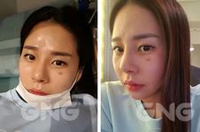 韩国GNG医院做隆鼻手术特点有哪些？