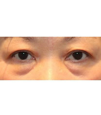 Arumlines整形医院-韩国美line整形医院下眼睑矫正手术对比图