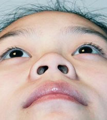 韩国美line整形医院鼻翼缩小术对比图