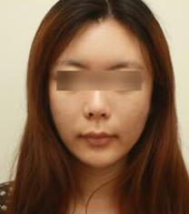 韩国美line整形医院3D全脸脂肪填充对比图