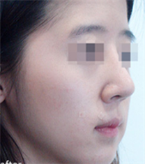 奥拉克医疗美容鼻部矫正案例