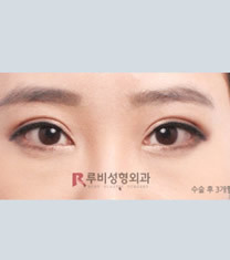 韩国如妃整形外科双眼皮手术对比图_术后