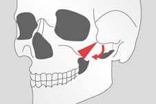 3D颧骨旋转术会导致面部下垂吗？