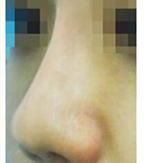 韩国美line整形医院注射玻尿酸隆鼻对比图