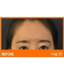 Arumlines整形医院-韩国美line整形医院切眉手术对比图