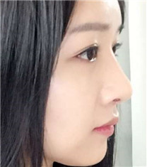 韩国玛博尔整形眼鼻整形+脂肪填充案例