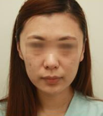 韩国美line整形医院3D全脸脂肪填充对比图