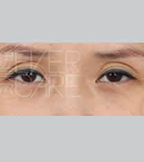 北京伊美尔医疗美容-北京伊美尔医疗美容提眉术案例对比图
