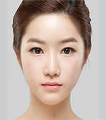 北京伊美尔医疗美容-北京伊美尔双眼皮+开眼角整形对比图