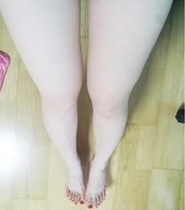 Arumlines整形医院-韩国美line整形医院大腿吸脂对比图