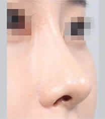北京伊美尔医疗美容-北京伊美尔医疗美容耳软骨隆鼻案例对比图