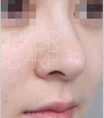 北京伊美尔医疗美容注射玻尿酸隆鼻对比图