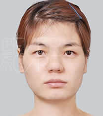 北京伊美尔医疗美容医院鼻综合整形对比图
