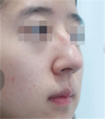 奥拉克医疗美容鼻部矫正案例