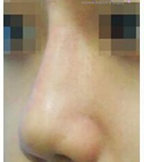 韩国美line整形医院注射玻尿酸隆鼻对比图_术前