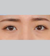 北京伊美尔医疗美容-北京伊美尔韩式切开法双眼皮对比图