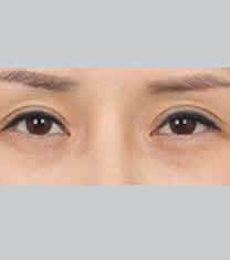 北京伊美尔医疗美容提眉术案例对比图