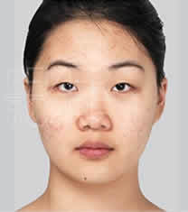 北京伊美尔医疗美容眼部综合整形案例对比图