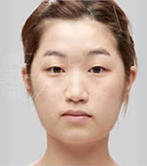 北京伊美尔医疗美容-北京伊美尔双眼皮+开眼角整形对比图