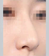 北京伊美尔医疗美容耳软骨隆鼻案例对比图