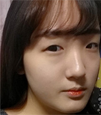 韩国dr朵整形医院-眼鼻轮廓整形对比案例