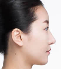 北京伊美尔医疗美容-北京伊美尔医疗美容医院驼峰鼻矫正对比图