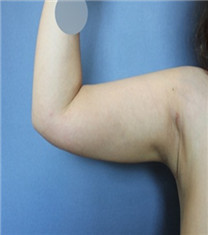 韩国Bommaru皮肤科-手臂吸脂对比图