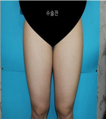 韩国Bommaru皮肤科-大腿吸脂对比图