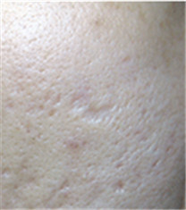 CNP皮肤科-痘疤对比日记