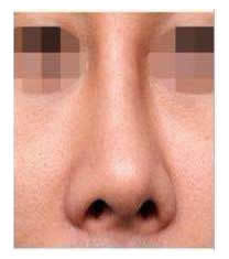 韩国春光整形外科歪鼻矫正对比图_术后